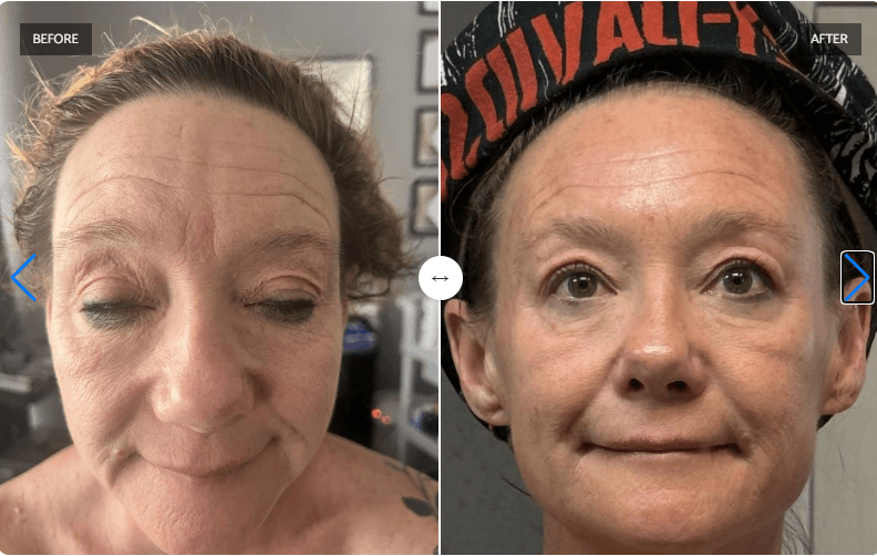 Glass Skin Sculpt Facial before and after result at Spa City Aesthetics